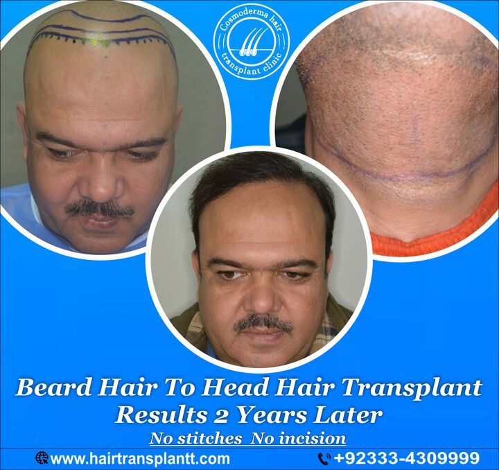 Beard body hair to head hair transplant result Lahore Dr Ahmad Chaudhry