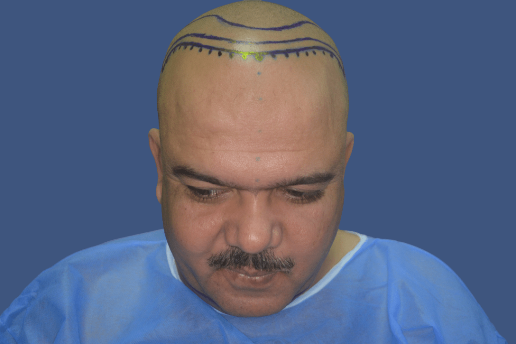 hair loss frontal area